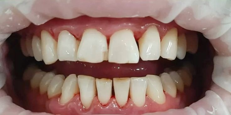 After stain and tartar removal at Smile+