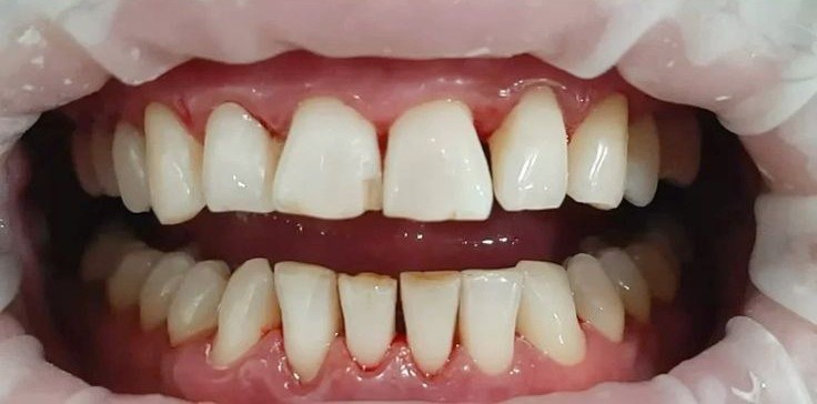 After cleaning and whitening treatment at Smile+