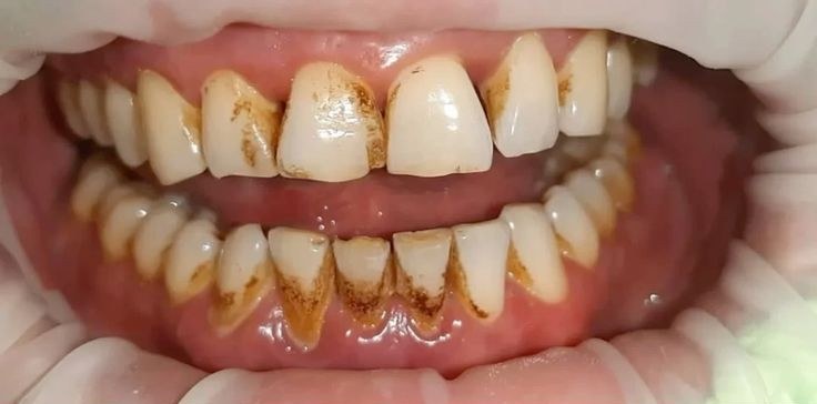 Before cleaning and whitening treatment at Smile+