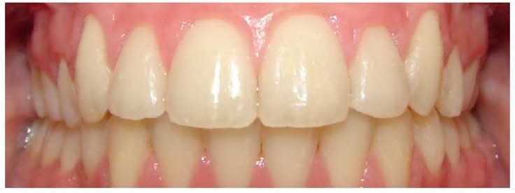 After smile alignment treatment at Smile+