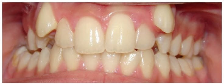 Before smile alignment treatment at Smile+