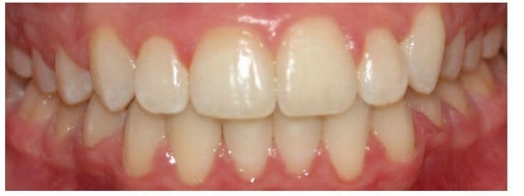 After smile correction treatment at Smile+