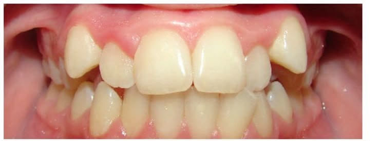 Before smile correction treatment at Smile+