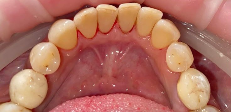 After deep cleaning treatment at Smile+