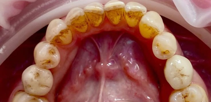 Before deep cleaning treatment at Smile+
