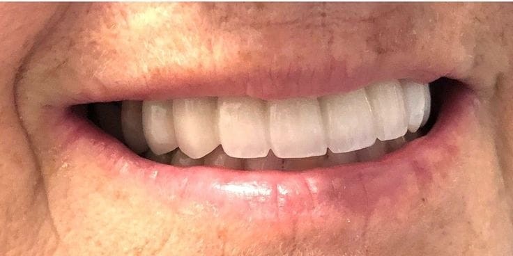 After implant restoration treatment at Smile+