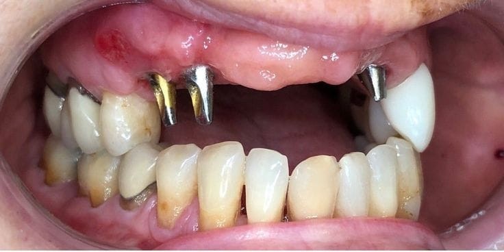 Before implant restoration treatment at Smile+