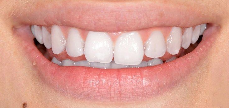 After teeth whitening treatment at Smile+