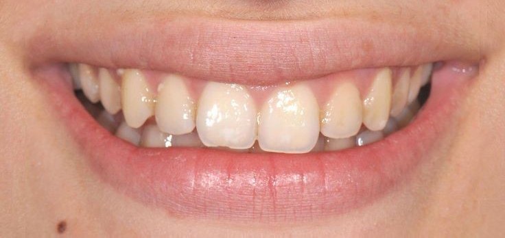 Before teeth whitening treatment at Smile+