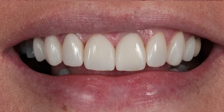 After porcelain veneers treatment at Smile+