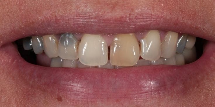 Before porcelain veneers treatment at Smile+